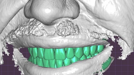 3D dental scanner Artec Space Spider - how to give dental implant patients their perfect smiles