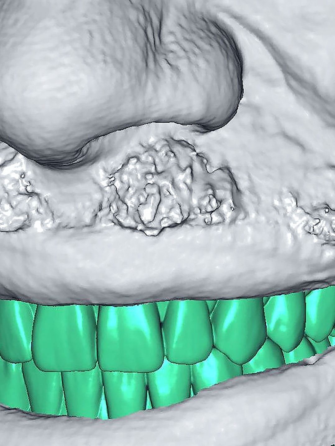 3D-Dentalscanner Artec Space Spider verhilft Zahnimplantat-Patienten zu einem perfekten Lächeln