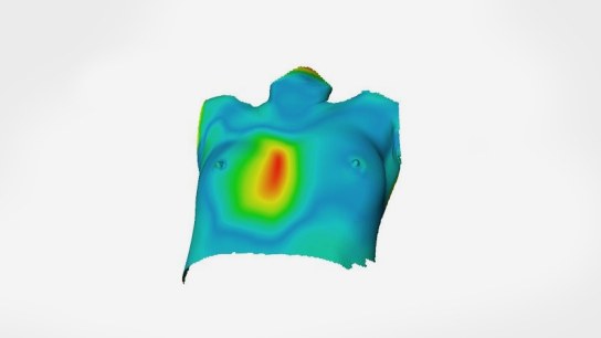 Сreating patient-specific chest implants with Artec 3D scanners and Geomagic Freeform software